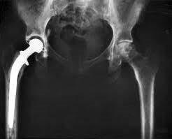 Orthopedic & Implants
